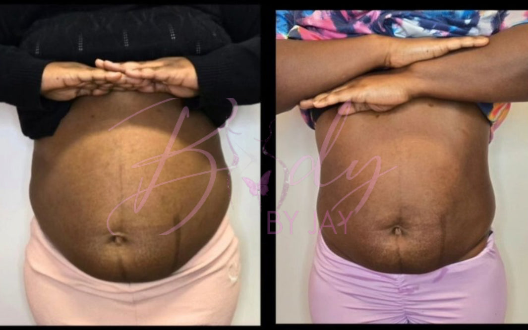 Weight loss bodysculpting