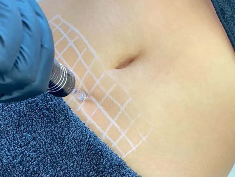 Virtual One On One Course- Hyaluron Pen Fat Dissolver For The Body